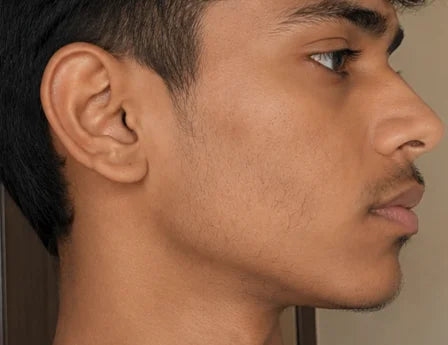 Patchy beard before image showing thin facial hair, sparse cheek beard, weak jawline beard, patchy beard growth, and minoxidil beard growth journey.