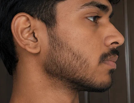 Fuller beard after image showing thicker facial hair, improved beard density, fuller jawline beard, patchy beard improvement, and minoxidil beard growth results.