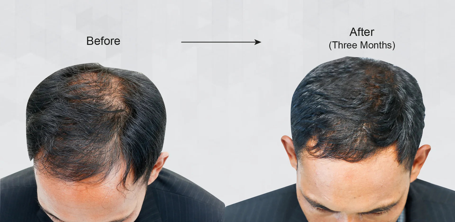 Before and after comparison showing improved hair density after three months of regular use of hair oil for men, highlighting the potential benefits of hair growth oil made with argan oil for hair and coconut oil for hair.