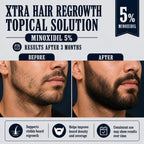 Before and after beard growth results with Xtra Hair Regrowth Topical Solution 5% Minoxidil, showing improved beard density, facial hair growth, patchy beard coverage, and visible hair regrowth treatment results.