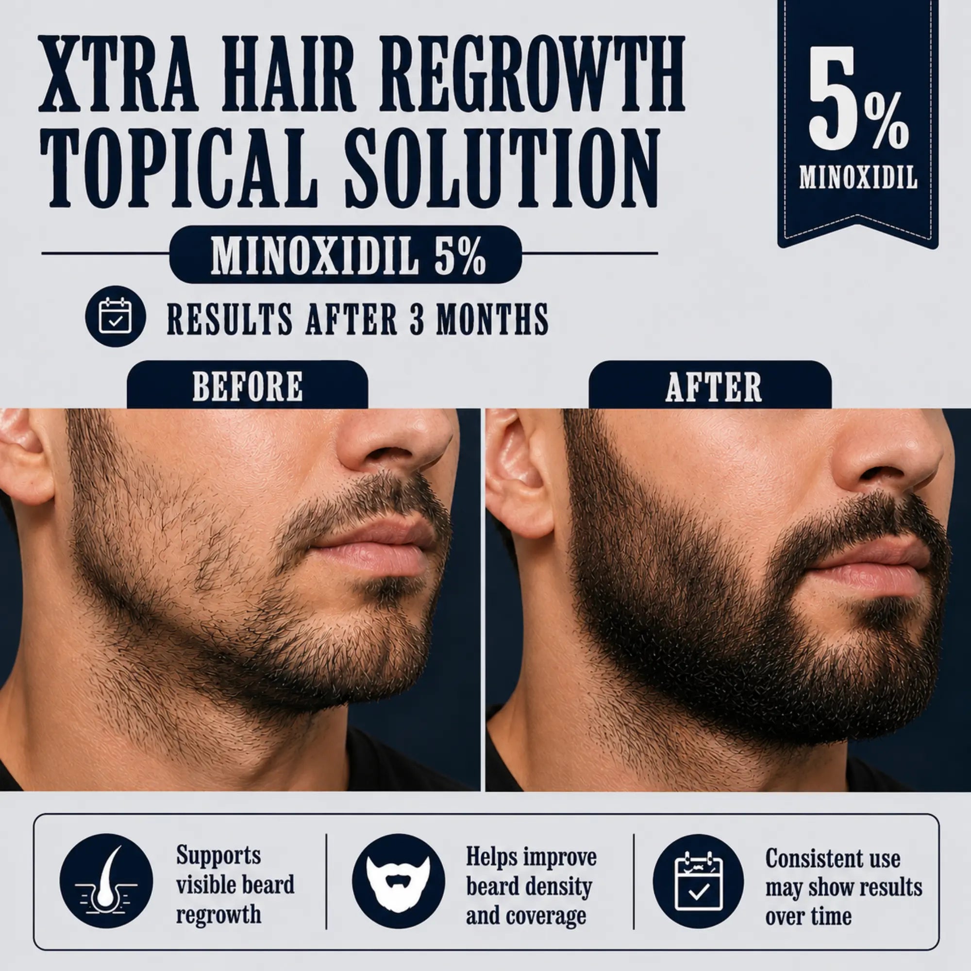 Before and after beard growth results with Xtra Hair Regrowth Topical Solution 5% Minoxidil, showing improved beard density, facial hair growth, patchy beard coverage, and visible hair regrowth treatment results.
